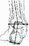 Physiology - Pronation, Supination and choosing the right footwear