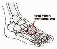 Stress Fracture