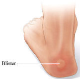 Blisters