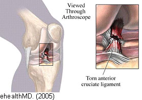 ACL Tear