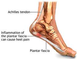 Plantar Fasciitis